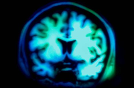 Terapia cu socuri electrice poate sterge din memorie amintirile negative