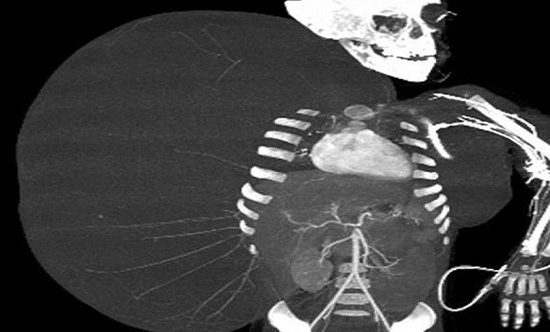 Premiera in lumea medicala. Copilul de 2 ani cu o tumoare mai mare decat trupul sau a fost operat