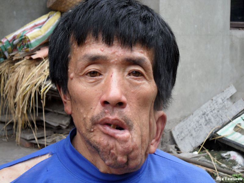 Omul cu fata "topita". Povestea barbatului care a ramas desfigurat dupa ce s-a ranit cand era copil