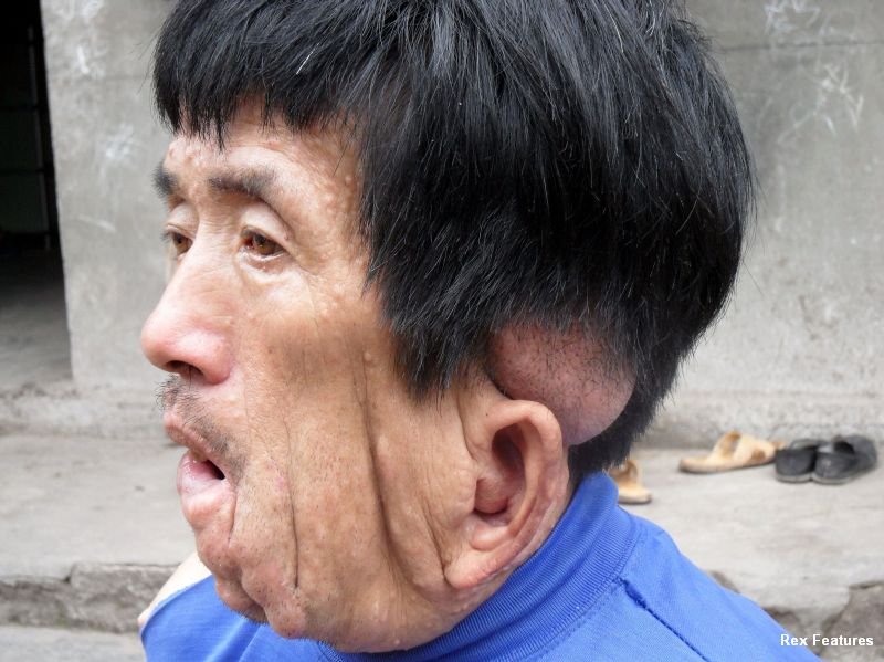 neurofibromatoza