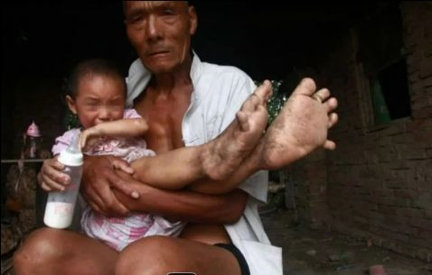 O fetita de 3 ani, din China, e nevoita sa mearga desculta, din cauza unei malformatii. VIDEO