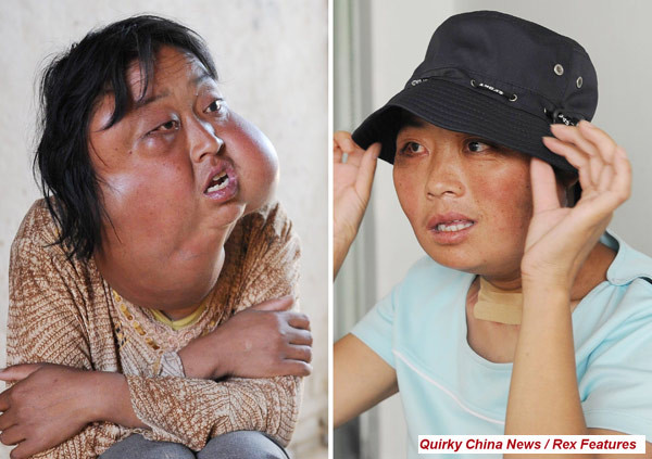 FOTO. Dovada ca oamenii pot face minuni. Cum arata acum aceasta femeie desfigurata de boala