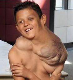 Drama unui copil de 9 ani cu o tumoare uriasa in jurul gatului este aproape de a lua sfarsit. VIDEO