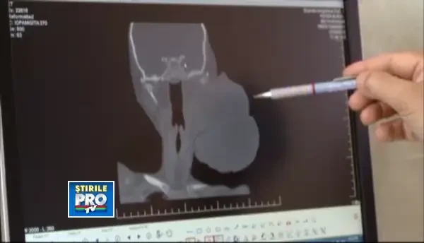 Viata unei copile din Cluj este pusa in pericol de o timora la cap de un kilogram