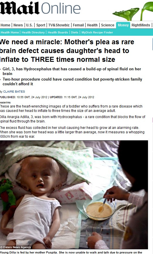 "E nevoie de un miracol". Singura sansa a unei fetite pe care boala o face sa para un extraterestru