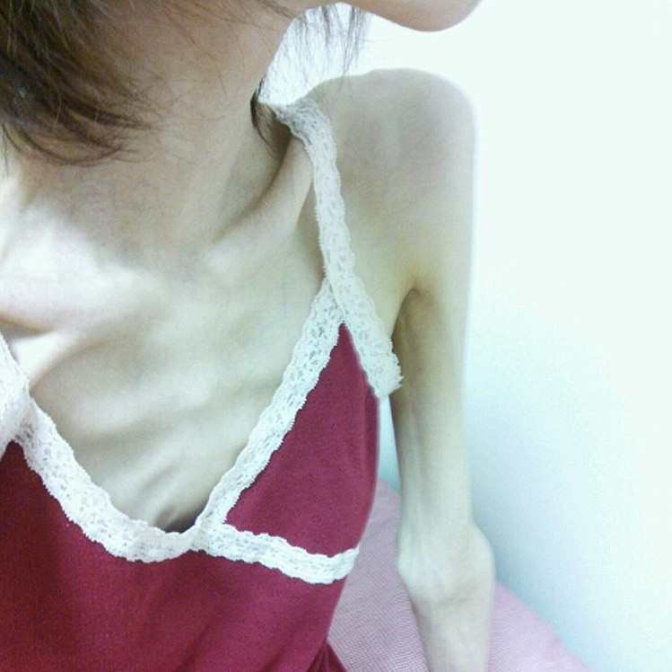 A sarit in bratele iubitului si si-a fracturat toate coastele. Cum arata azi tanara care suferea de anorexie