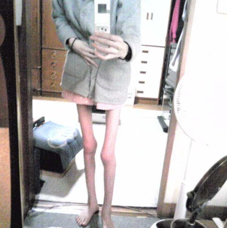 anorexica