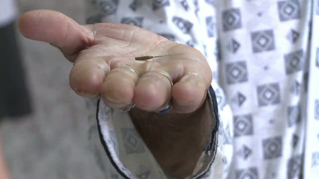 Anuntul unui dentist pentru pacientul pe care il trata: "Tocmai ati inghitit un ac"