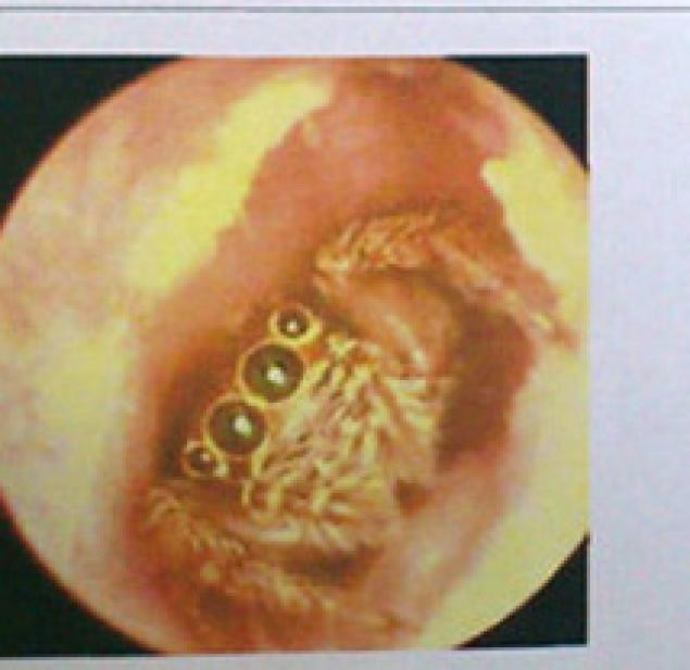 FOTO. O femeie a stat cu un paianjen in ureche timp de 5 zile, fara sa-si dea seama