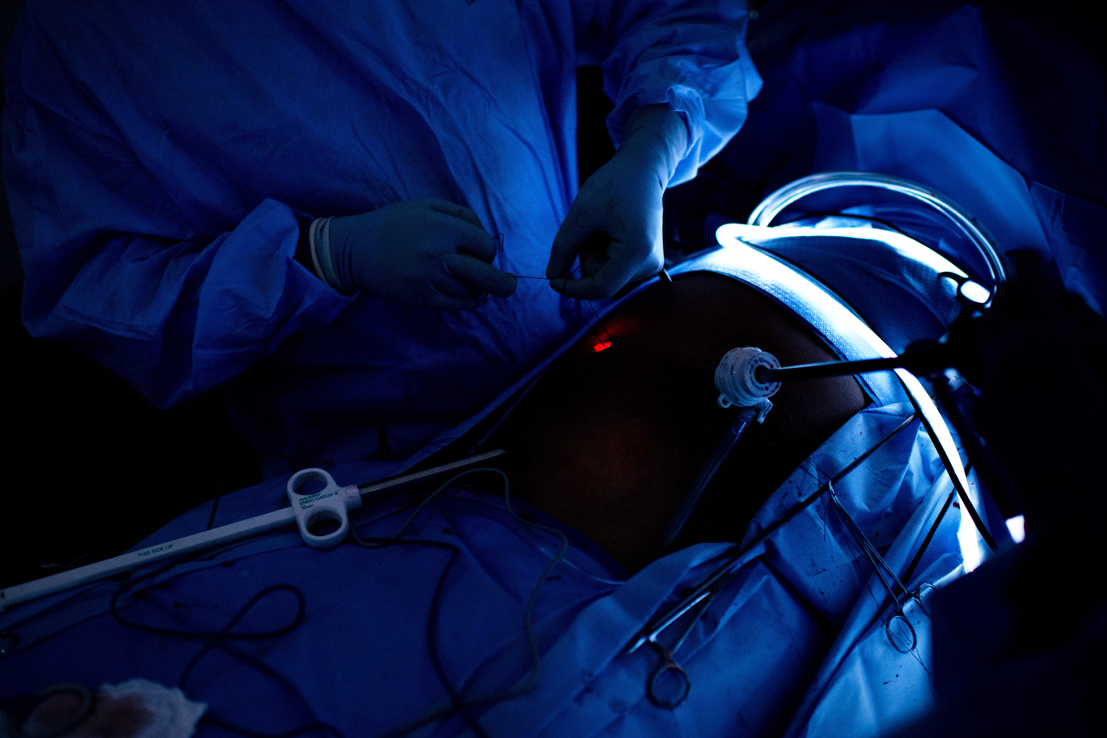 O asistenta a aruncat rinichiul sanatos al unui donator in timpul unei operatii de transplant