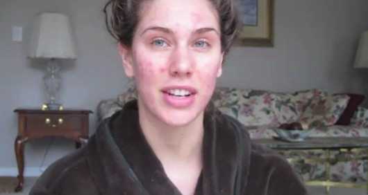 Nu s-a mai dus la scoala din cauza problemelor de pe chip. Acum e favorita designerilor la New York