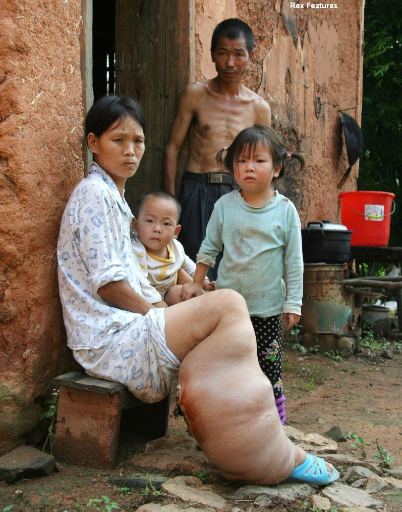 Drama unei femei din China care nu are bani pentru a-si trata piciorul si va trebui sa-l amputeze