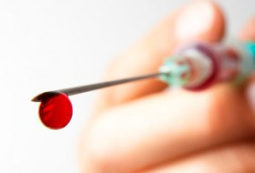 "Liftingul vampir", alternativa la botox. Raspunsul la problemele de frumusete curge chiar prin vene