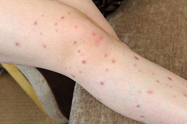 "Trupul meu nu se va vindeca niciodata". Drama unei mame alergica la propriul ei copil