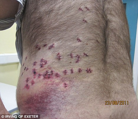 Boala care l-a ajutat sa pacaleasca moartea. Cum a supravietuit acest barbat injungiat de 38 de ori