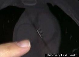 Radiografie - cui in inima