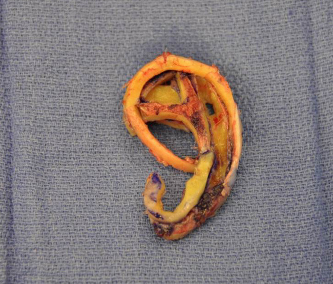 "Mi-a crescut urechea in antebrat". Care este explicatia pentru acest procedeu bizar