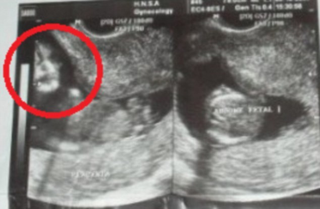 Ecografia acestui copil i-a inspaimantat pe parinti. Ce au vazut cand s-au dus la spital