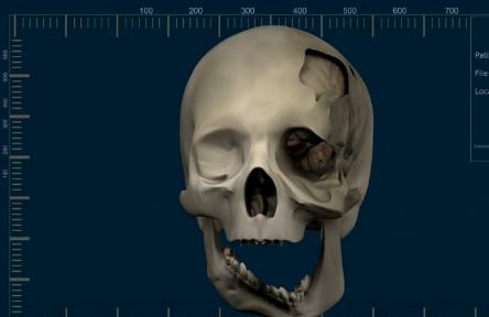 "Mi-a mancat jumatate din chip si mi-a lasat afara creierul". O tanara sufera de o boala teribila