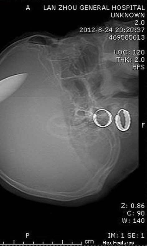 Cea mai SOCANTA radiografie. Cand au vazut-o medicii au INCREMENIT. "N-avem ce sa ii facem"