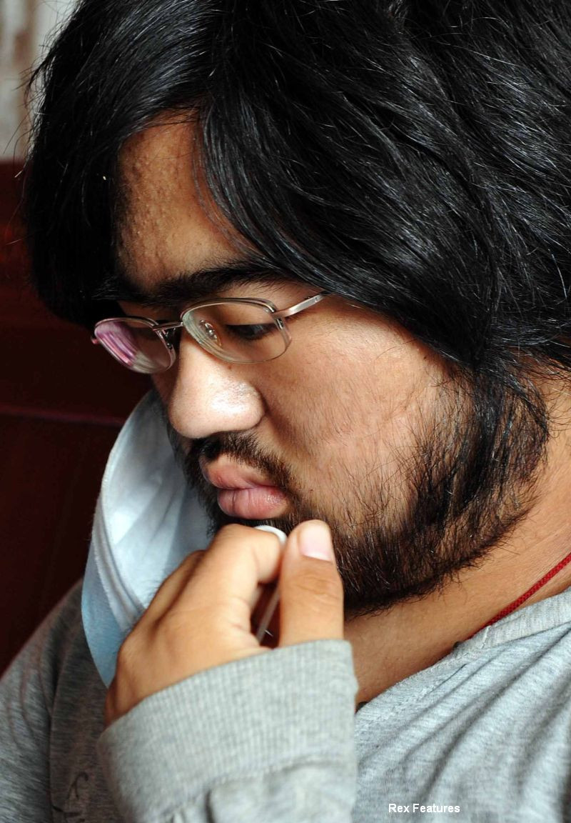 Tratamentul care i-a salvat viata i-a si distrus trupul.Povestea impresionanta a unei fete din China