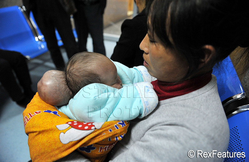Un copil cu doua capete s-a nascut in China. "Nu ne-a lasat inima sa o abandonam"