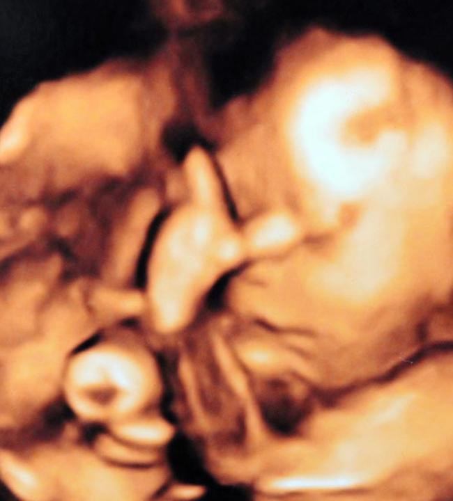 FOTO. Surpriza de proportii pentru o tanara care si-a facut o ecografie de sarcina.Ce apare pe ecran