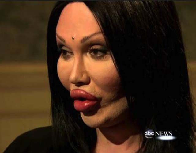 "Am vrut sa fiu frumoasa, dar nu mi-a iesit". Ce se intampla cand exagerezi cu chirurgia estetica