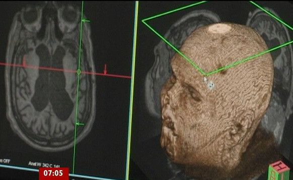 Primul om din lume care comunica prin PUTEREA GANDULUI. Ce le-a transmis medicilor