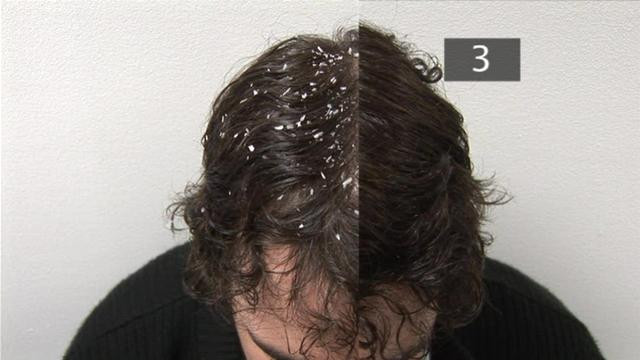 Cum prevenim formarea MATRETII si cum o inlaturam