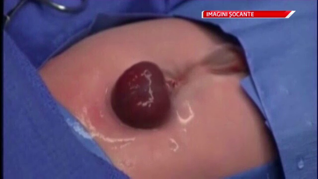 Un barbat din China, nascut cu o problema cardiaca neobisnuita, va fi operat, dupa 24 de ani