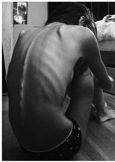 FOTO. Cum arata dupa 4 ani aceasta tanara care ajunsese sa fie ca un schelet ambulant