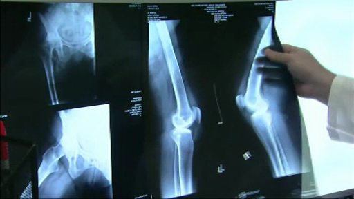 Cum te poate baga moda in spital ."Atentie la blugii skinny. Produc leziuni permanente ale nervilor"