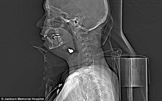 Radiografie - glont