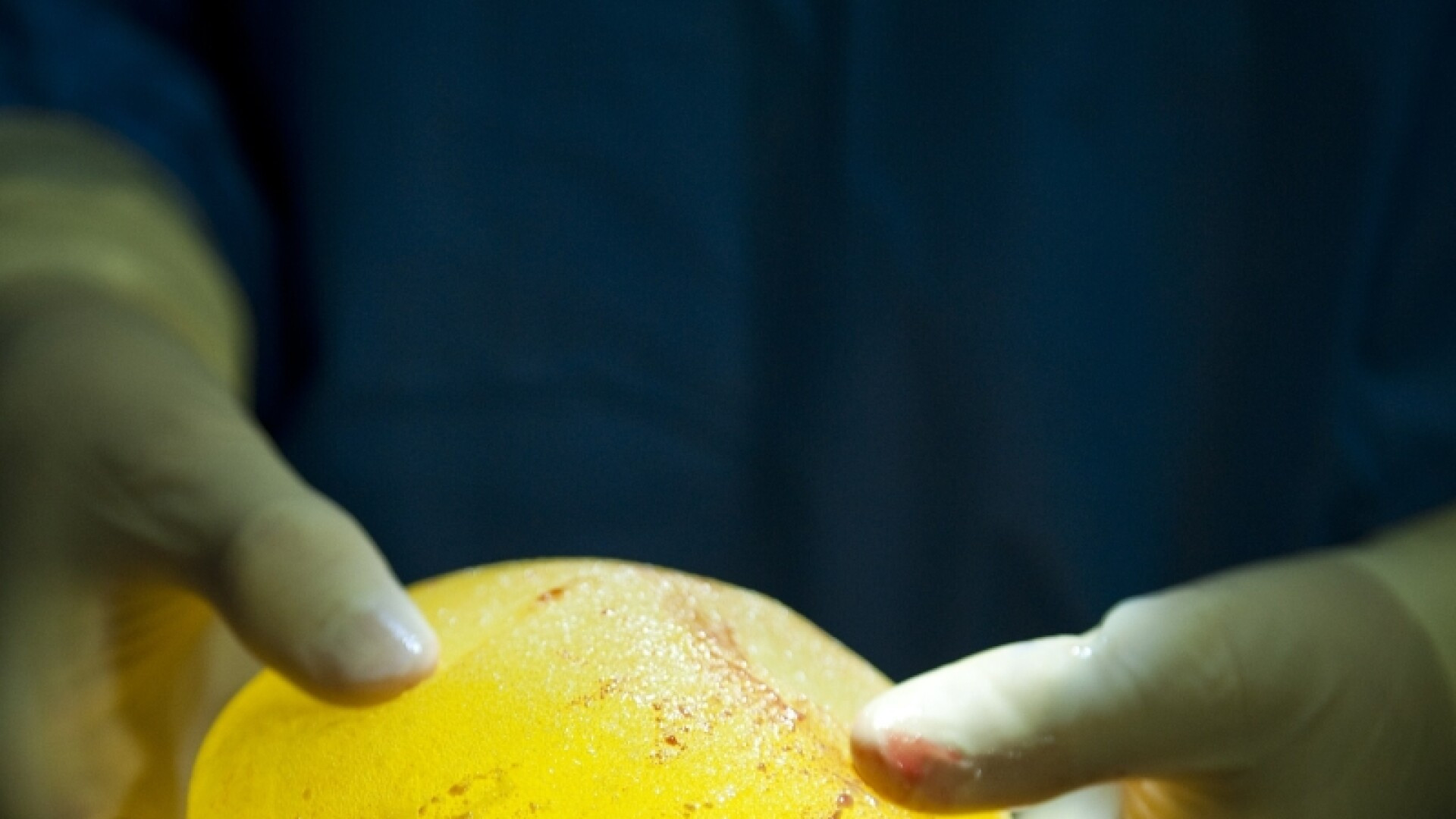 Femeia de 30 de ani care a intrat in coma dupa o interventie pentru marirea sanilor a murit