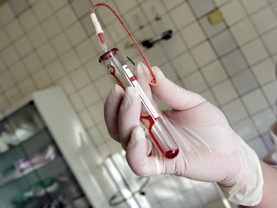 Cum depistati hemofilia de tip A la copii si ce analize trebuie facute