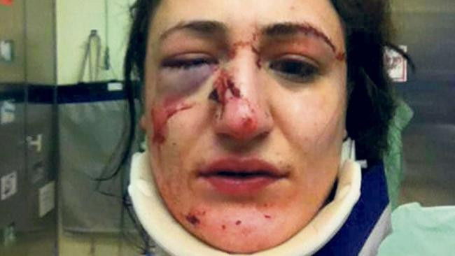 Femeie desfigurata de politistii din Munchen. "A fost autoaparare, ea ne-a atacat prima". FOTO