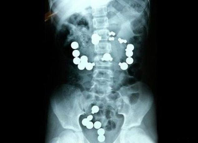 Ce au vazut medicii in radiografia unui copil de 18 luni. "Nu stim cum s-a putut intampla asta"