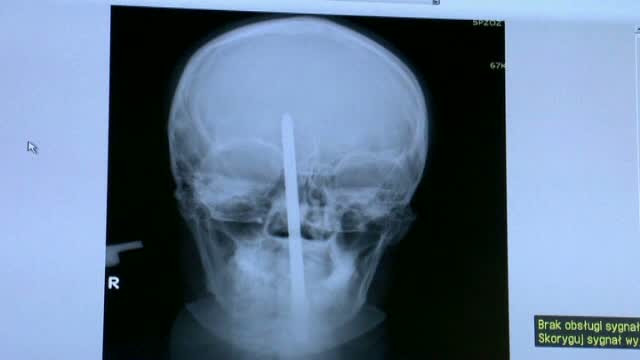 Un polonez a supravietuit dupa ce o surubelnita i s-a infipt in frunte, perforandu-i creierul