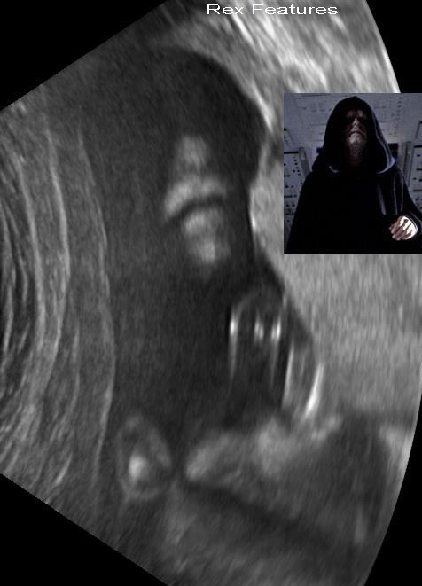 Descoperirea facuta la ecograf de o viitoare mamica i-a trasformat bebelusul nenascut in star. FOTO