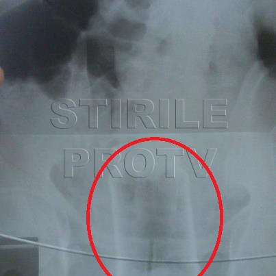 "Curiozitatea" l-a trimis la urgente. Un barbat din Galati, la un pas de moarte dupa un gest stupid