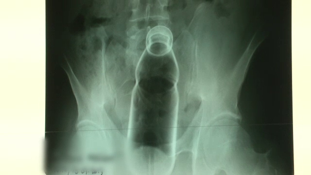 Gestul extrem al unui barbat din Botosani care si-a riscat viata pentru cateva momente de "placere"