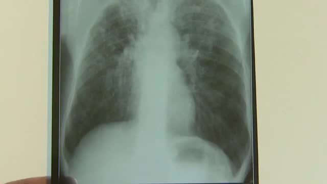 Romania a primit 5 mil. dolari pentru a opri imbolnavirile cu o forma de TBC rezistenta la tratament