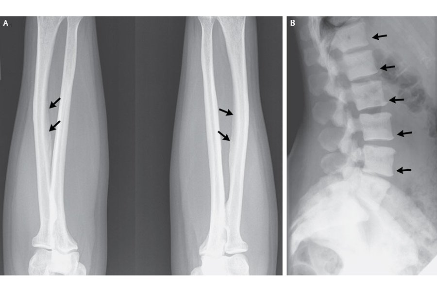 radiografie, oase