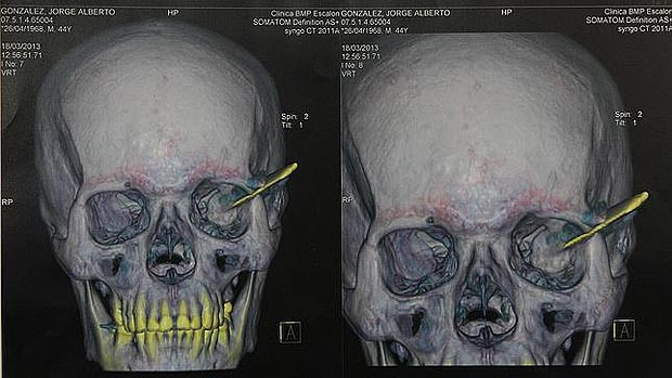 Un barbat a trait timp de 18 ani cu un cutit in cap, dupa ce a fost implicat intr-o bataie de strada