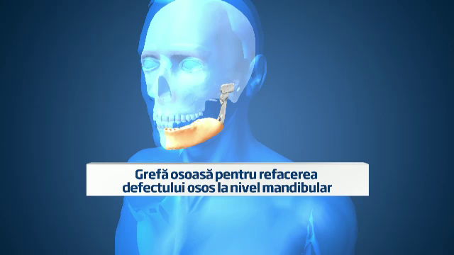 Ionut Mironica,barbatul salvat de o interventie medicala rara.Cum i-au reconstruit complet maxilarul
