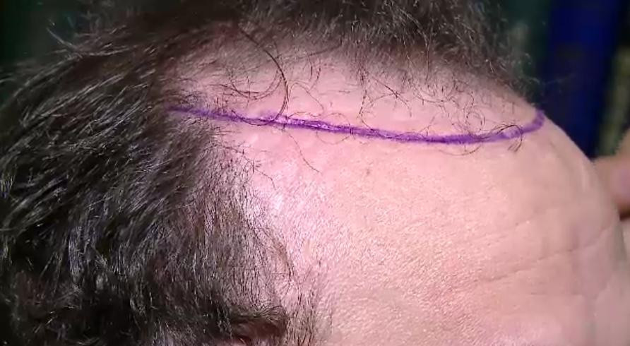 "Mi-au ciuruit capul" Mihai Traistariu s-a trezit plin de cicatrici si cu dureri ingrozitoare