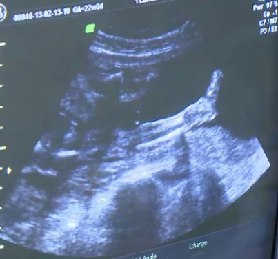 Au mers la medic pentru a afla daca vor fi parinti de baiat sau fata. Imaginea de la ecograf i-a speriat. FOTO