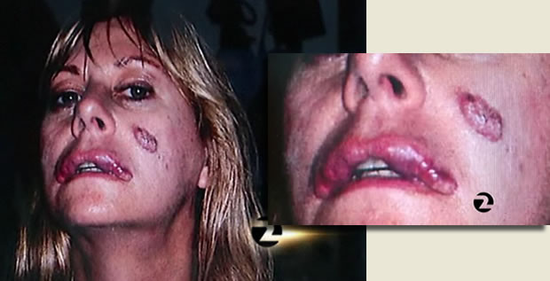 Femeia, ajunsa un "monstru" din dorinta de a fi frumoasa. "O sa traiesc cu asta toata viata!"