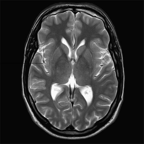 Ce au descoperit medicii in creierul unui copil de 9 ani, dupa ce bunicii au observat ca falseaza